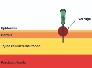 Técnica multipunción de Falknor