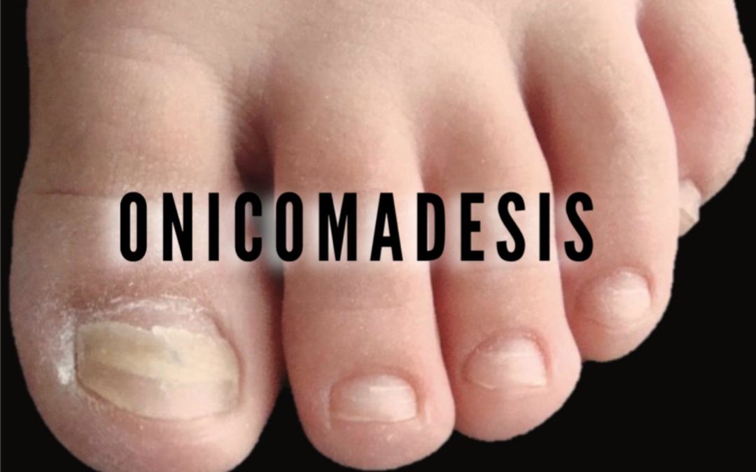 Onicomadesis: caída de uñas y cómo tratarla en los pies