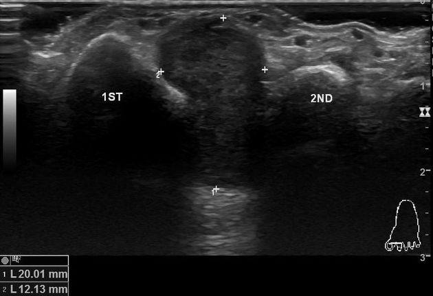 Neuroma de Morton: El Rol Clave de la Ecografía Musculoesquelética