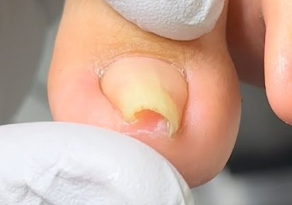 Uñas en pinza en Lepe: tratamiento definitivo y cuándo operar