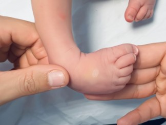 Pie Equinovaro Congénito: Claves para su Comprensión y Tratamiento Temprano