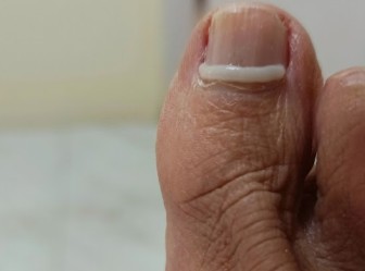 La revolución en podología: El tratamiento invisible que endereza tus uñas de forma natural 🚀