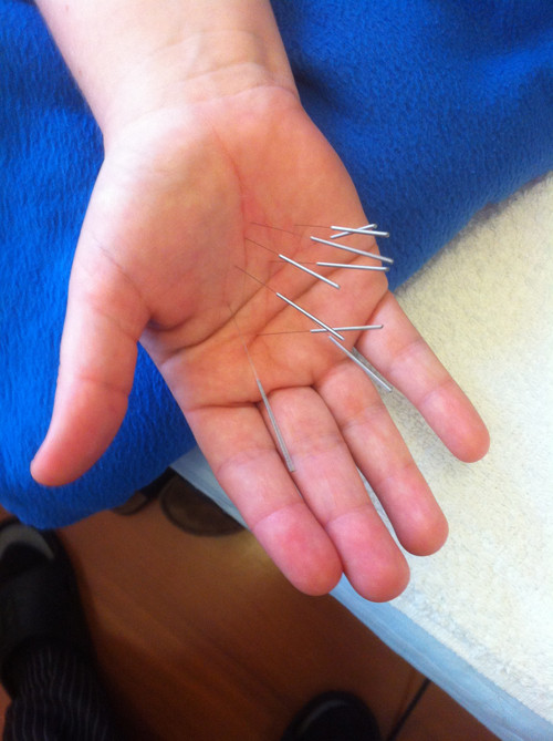 Balance Acupuncture Acupuncture in Eastern District of Auckland & Thames