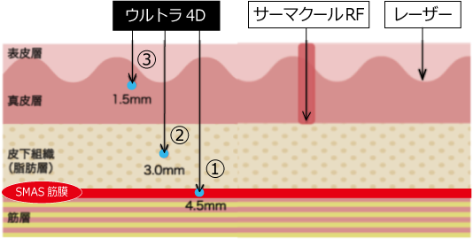 札幌　ハイフ　HIFU　ゴルゴライン　筋膜　短期間　短時間　豊平　小顔　たるみ　法令線　ニキビ