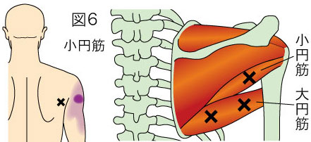 小円筋トリガーポイントによる肩の痛み