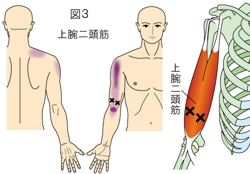トリガーポイントによる体幹上部と上肢の痛み・2 - やまだカイロ