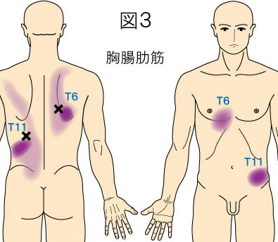 胸腸肋筋トリガーポイントによる背部と腹部の痛み