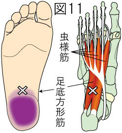 足底方形筋トリガーポイントによる足の痛み