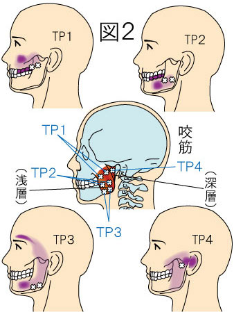 咬筋トリガーポイントによる頭痛と顔の痛み