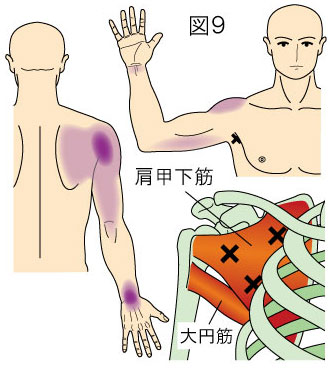 肩甲下筋トリガーポイント」による肩甲骨、肩、上腕、手の痛み