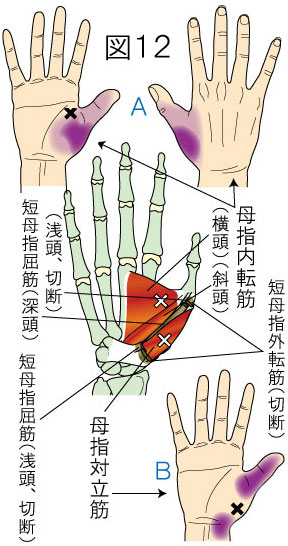 母指内転筋・母指対立筋トリガーポイントによる手・指の痛み