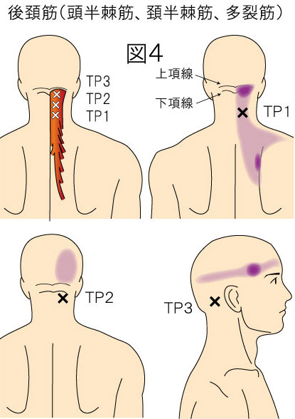 後頚筋：頭半棘筋・頚半棘筋・多裂筋トリガーポイントによる痛みとしびれの領域