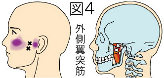 外側翼突筋トリガーポイントによる顔と顎の痛み
