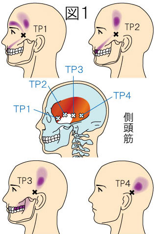 側頭筋トリガーポイントによる頭痛と顔の痛み