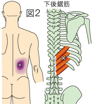 トリガーポイントによる腰痛・背部痛・殿部の痛みと腹痛