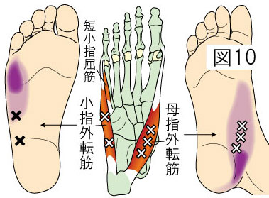 小指・母指外転筋トリガーポイントによる足の痛み