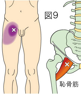 恥骨筋トリガーポイントによる鼡径部と大腿の痛み