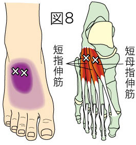 短指伸筋トリガーポイントによる足の痛み