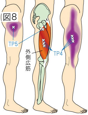 外側広筋トリガーポイントによる股関節・大腿・膝の痛み