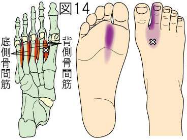 骨間筋トリガーポイントによる足の痛み