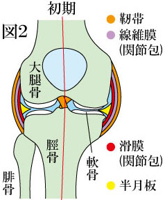 変形性膝関節症　初期