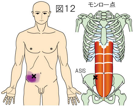 トリガーポイントによる体幹の痛み やまだカイロプラクティック 鍼灸院ホーム ページ