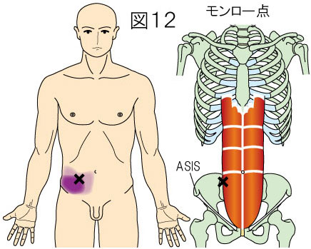 腹直筋外縁（モンロー点）トリガーポイントによる腹痛（下腹部痛）