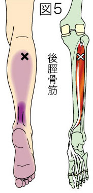 後脛骨筋トリガーポイントによる下腿と足の痛み