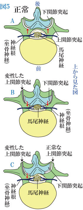 変性すべり症と片側すべり症