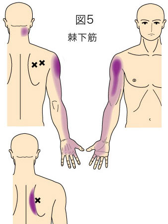 棘下筋トリガーポイントによる首、上背部、上肢の痛み
