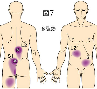 多裂筋トリガーポイントによる背部と腹部の痛み