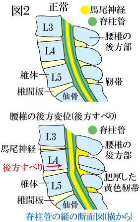 腰部脊柱管狭窄症と腰椎後方すべり