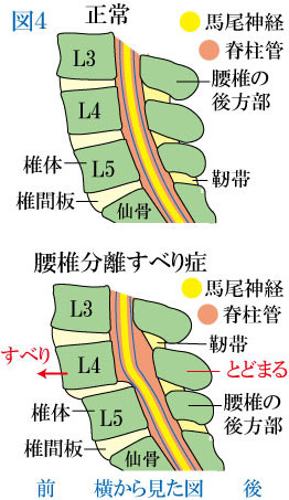 分離すべり症の脊柱管