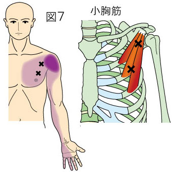 小胸筋トリガーポイントによる胸と上肢の痛み