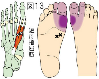 短母指屈筋トリガーポイントによる足の痛み