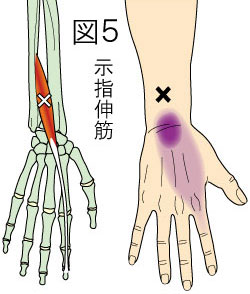 示指伸筋トリガーポイントによる手の痛み