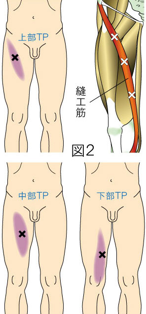 縫工筋トリガーポイントによる大腿・膝の痛み