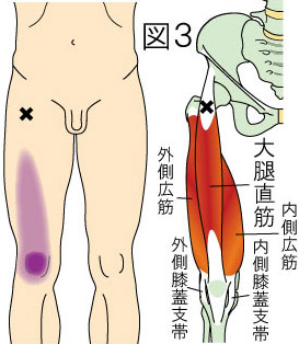 大腿直筋トリガーポイントによる大腿と膝の痛み