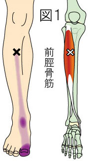 前脛骨筋トリガーポイントによる下腿と足の痛み