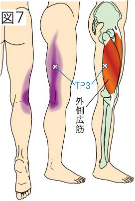 外側広筋トリガーポイントによる大腿と膝の痛み