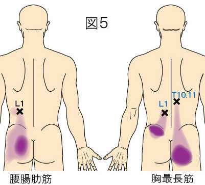 腰腸肋筋・胸最長筋トリガーポイントによるお尻の痛み（殿部痛）