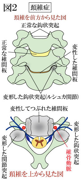 頚椎症　変形