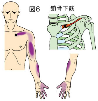 鎖骨下筋トリガーポイントによる胸と手の痛み