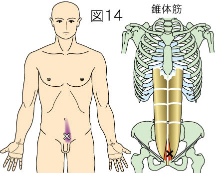 錐体筋トリガーポイントによる腹部（下腹部）の痛み