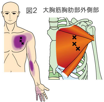 大胸筋肋骨部トリガーポイントによる胸と上肢の痛み