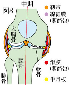 変形性膝関節症　中期