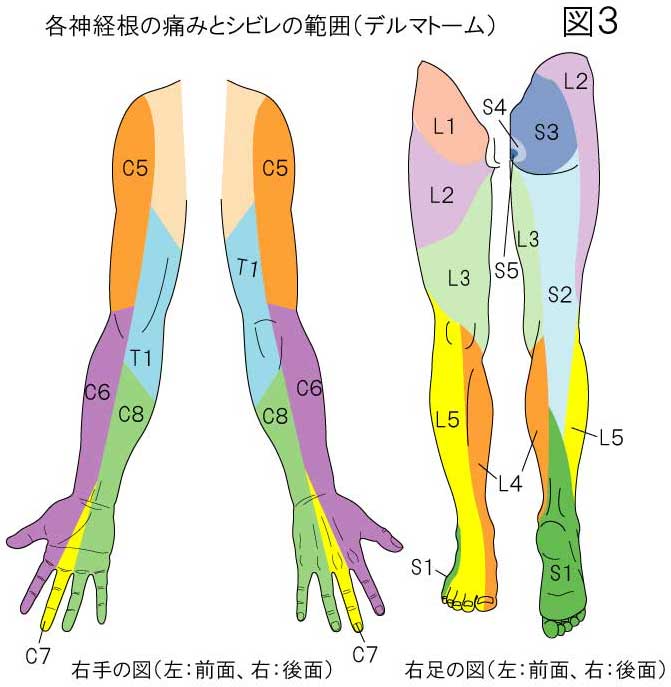 神経根の痛みとシビレの範囲：デルマトーム