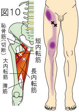 長内転筋・短内転筋トリガーポイントによる大腿・膝・下腿の痛み