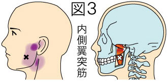 内側翼突筋トリガーポイントによる顎と顔の痛み