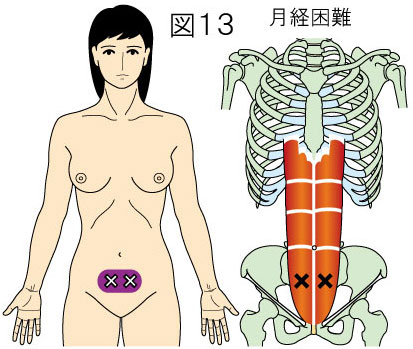 腹直筋トリガーポイントによる月経困難と下腹部の痛み